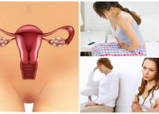 7 cosas que debes saber sobre el síndrome de ovario poliquístico